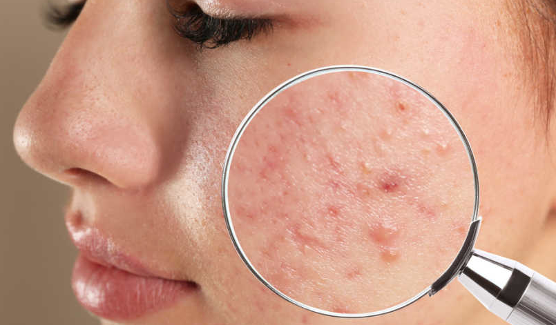 Mengatasi Jerawat Stres