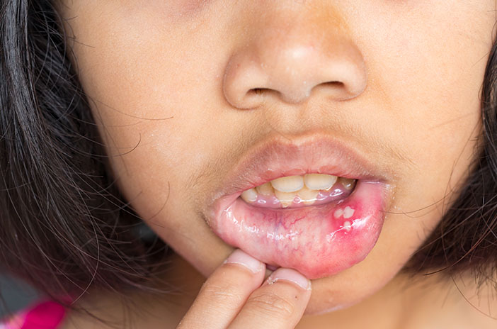 Mengapa Sariawan Berwarna Kuning